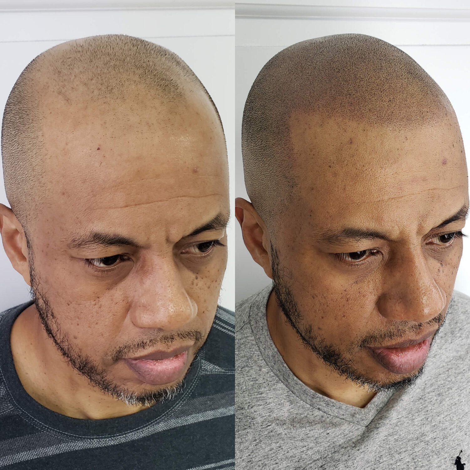 Micropigmentation